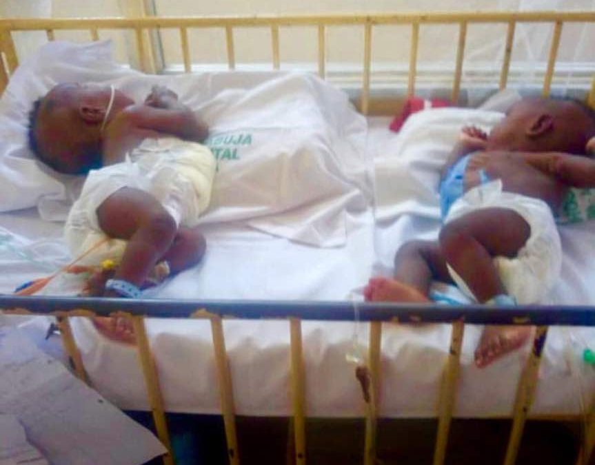 UATH doctors successfully separate conjoined twins in Gwagwalada